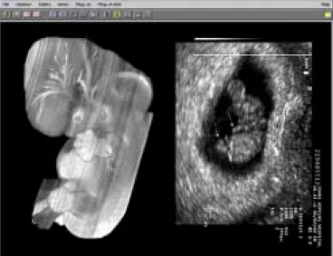 Figure 3: UFL volume rendering of MRM image from a Stage 14 embryo  And JHMI Rhombencephalon Saggital View Stage 18 