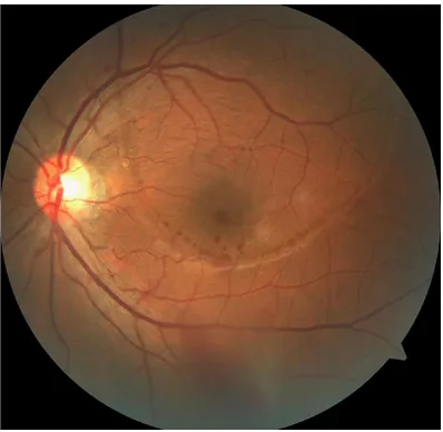 Figure 1. Image of the ocular fundus of the patient before the treatment.
