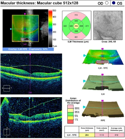 Figure 8. Optical coherence tomography (OCT) image of the patient 1 week after the laser treatment.