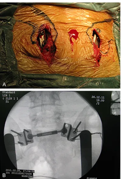 Figure 3. A. Intraoperative view of the placement of MIAP. B. Intraoperative fluoroscopy image demon-strated the position of the MIAP and the reduction of the fractures.