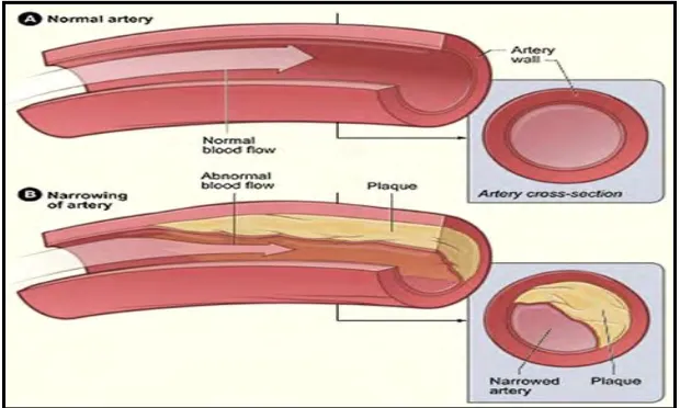 Figure 2.1.1.2: Comparison between normal and abnormal heart. 