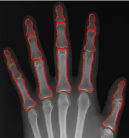 Fig.  15(a)  and  Fig.  16(a)  show  the  radiographs  for  the  left  and  right  hands  to  be  processed,  respectively