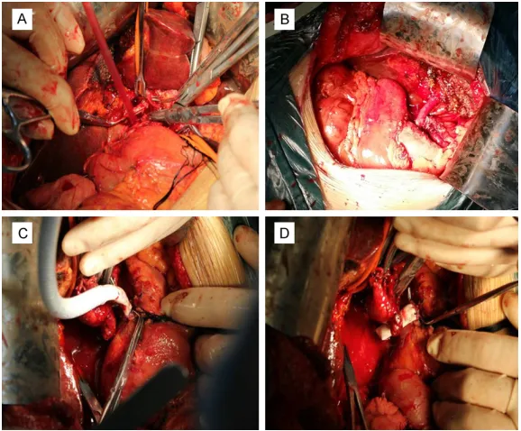 Figure 1. Portal vein resection and reconstruction with vascular graft. A: Ready for resection; B: Removed the tumor mass with left hepatectomy; C: Vascular graft anastomosis with distal portal vein; D: Vascular graft anasto-mosis with proximal portal vein.