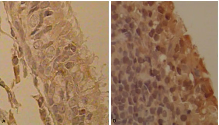 Figure 1. The expression level of DNA-PKcs in tumor tissues (Tumor) and normal mucosa tissue (Normal)