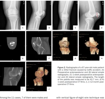 Figure 2. Radiographs of a 67-year-old male patient with a 34A2 fracture caused by traffic accident