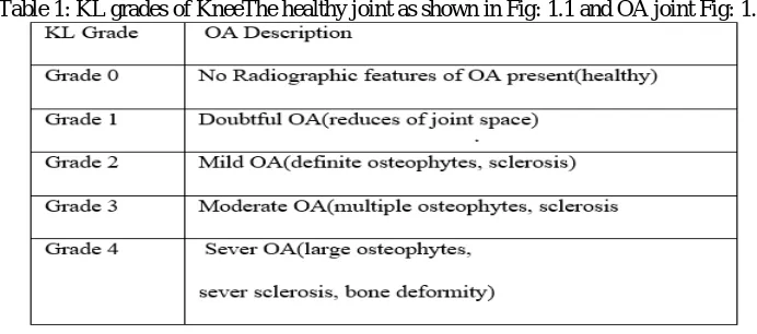 table 1  Table 1: KL grades of KneeThe healthy joint as shown in Fig: 1.1 and OA joint Fig: 1.2 