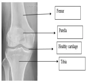 Fig 1.1: Healthy knee joint                          Fig 1.2: Osteoarthritis joint 