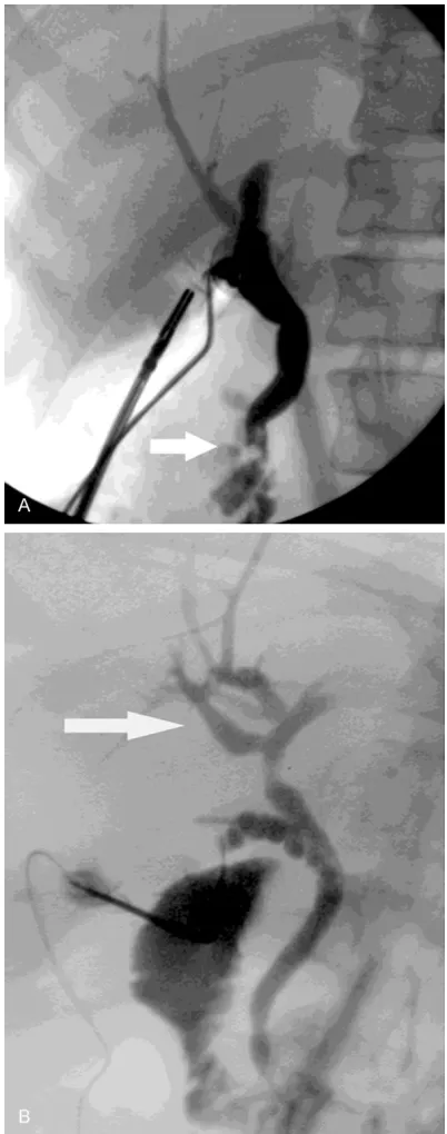 Figure 1. A: Intraoperative cholangiography showing common bile duct stones (white arrow); B: Anatomi-cal variation of the biliary tree at level of the right he-patic duct (merger failure between the right posterior and the right anterior segmental branch) before the common bile duct takes form (white arrow).