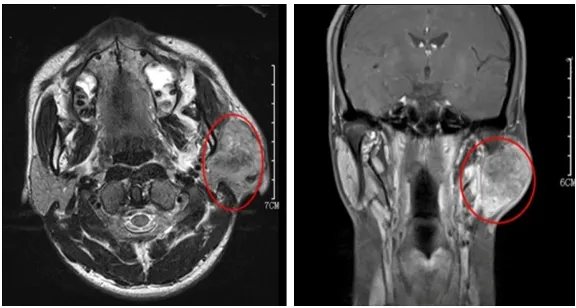 Figure 2. Specimen of parotid tumor (A) was medium hardness with com-plete capsule, and (B) presented a dark brown dissection.