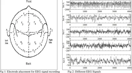 Fig 3 shows the algorithm proposed to classify EEG signals of normal subjects with their eyes open and subjects displaying epileptic activities