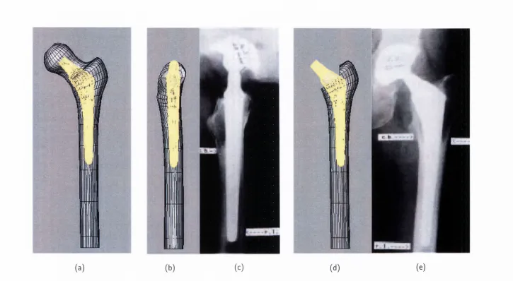 Figure 3.6. Stem resection and positioning (a) positioning of stem in the intact femur, (b) medial view of stem position with head resected, 