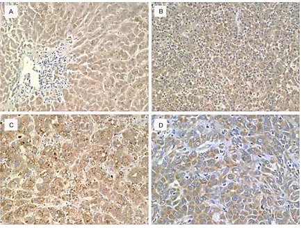Figure 4. Results of immunohistochemical staining for expression of VEGF in the HCC samples