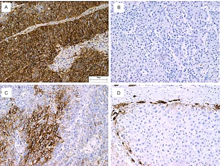 Figure 5. Results of immunohistochemical staining for expression of VEGFR in the HCC samples