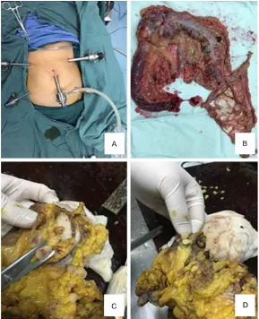 Figure 1. The surgery in the LC group. A: Trocar position of L-CME. B: The right hemicolon specimen