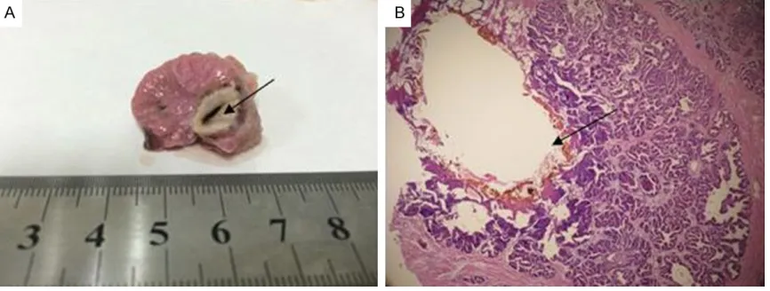 Table 1. Influence of different single focus laser time and power on canine prostate ablation