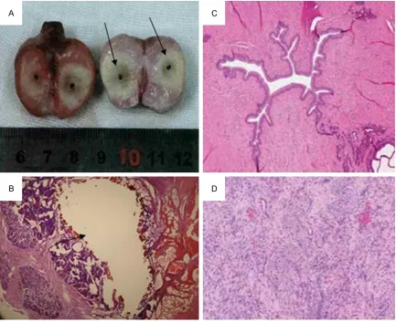 Figure 3. Canine prostate histopathologic examination after bilateral focal Nd: YAG. A: Represents TTC staining of prostate gross cross-sectional slices where there were two distinct vaporizing cavity areas in the ablation zone