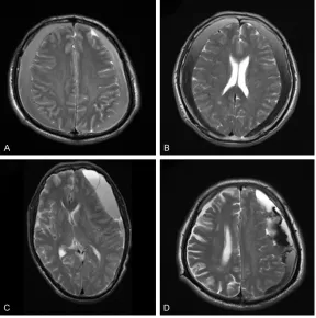 Table 2. The ferrum and VEGF levels in chronic subdural hema-toma and peripheral blood by classification of MRI pattern