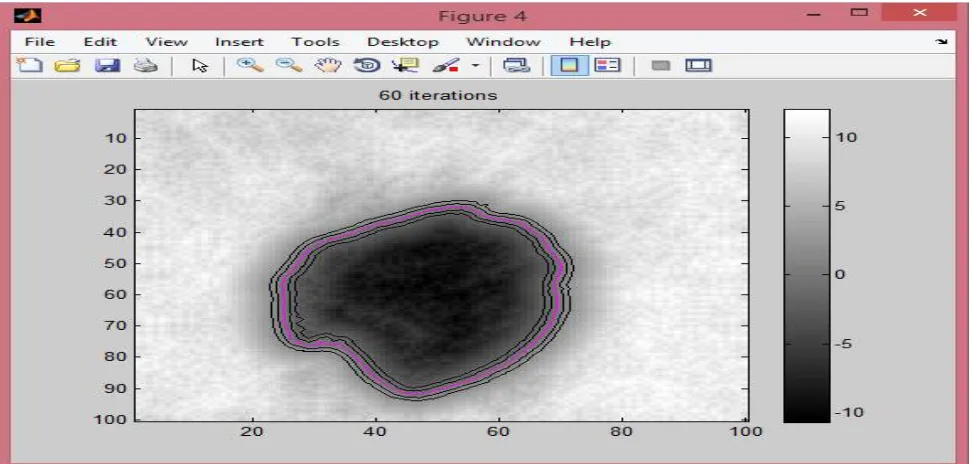Fig 5 shows the processing of fundus image performed in MATLAB to Extract the Opric Disc and Opric Cup to find the Cup-to-Disc ratio to detect the glaucoma disease