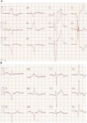 Figure 1. Comparation of QRS complex between before and after RAAV LUV pacing. A: Before CRT (CLBBB, QRS duration was 200 ms under intrinsic atrioventricular conduction)