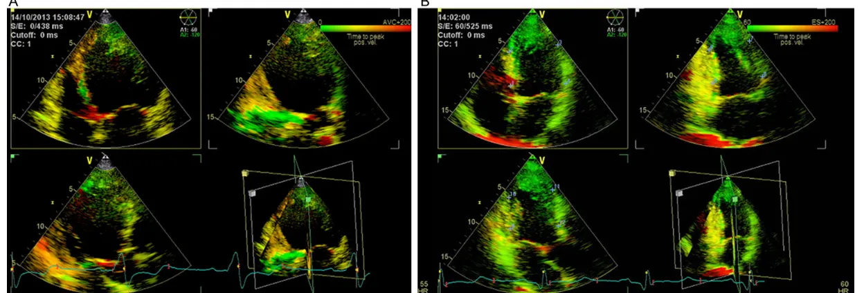 Figure 3. Ts-SD12 at base and papillary level were also improved 12 months after RAAV LUV pacing