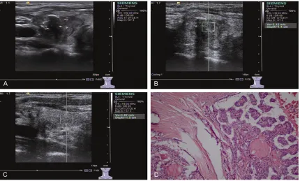 Figure 2. Nodular goiter in the same patient of Figure 1 with a 3.2×4.3 mm nodule in right thyroid lobe