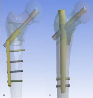 Figure 1. A: CAD model of AO 31-A2.1 fracture fixed with DHS. B: CAD model of AO 31-A3.1 fracture fixed with Gamma nail.