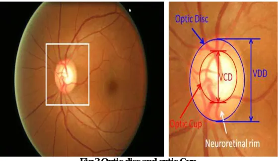 Fig 3 Optic disc and optic Cup 
