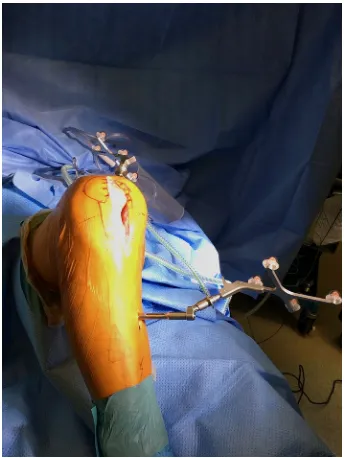 Fig. 6  Minimally invasive total knee arthroplasty using computer-assisted navigation technology