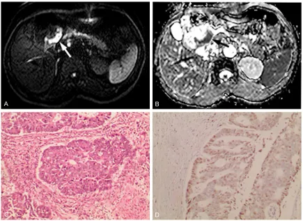 Table 4. Diagnostic cutoff of ADC value to distinguish TNM stages, histological type, and Ki-67 LI