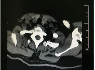 Figure 1. Preoperative CT scan of the neck region. Low density mass was observed in the both lobes of the thyroid