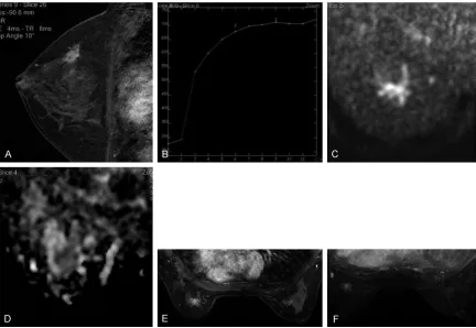 Figure 3. The sub-classification of the breast cancer of a 69 years old female, whose pathological result was cancer with early soaking in the tubes