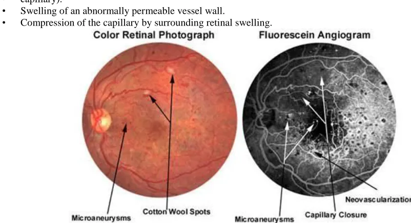 Fig 1.1: Retinal capillary closure 