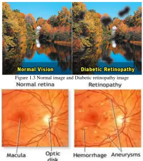 Fig 1.2: multiple micro aneurysms 