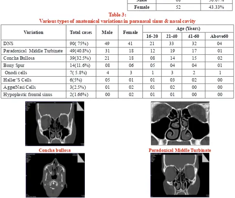 Table 3: Various types of anatomical variations in paranasal sinus & nasal cavity