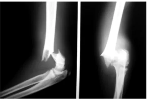 Figure 2. Post-operative X-rays of elbow-AP and lateral views after pinning in displaced humerus fracture in  children