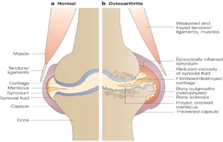 Figure 1.1 Knee anatomy in normal and osteoarthritic states.Taken fromhttps://sciencebasedmedicine.org/.
