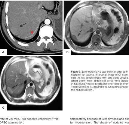 Figure 3. Splenosis of a 41-year-old man after sple-nectomy for trauma. In arterial phase of CT scan-