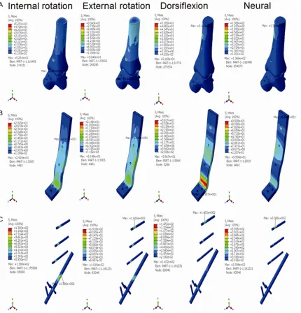 Figure 3. The stress distribution of the anterior plate plus posterolateral screw ankle fusion model at the internal rotation state, the external rotation state, the dorsiflexion state, and the neutral state
