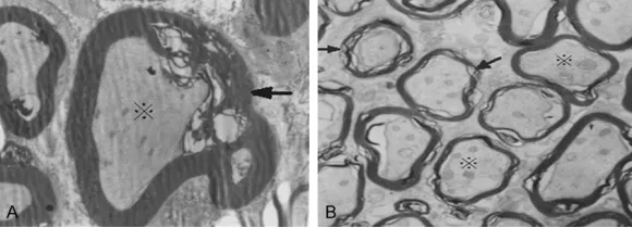Figure 2. Transmission electron microscopy of nerves in experimental animals with significant hearing loss