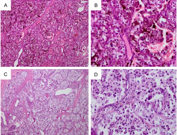 Figure 5. Post-operative pathological hematoxylin-eosin (HE) staining and HE depigmentation staining images of this patient