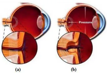 Figure 1: (a) Normal Eye (b) Glaucoma Eye 