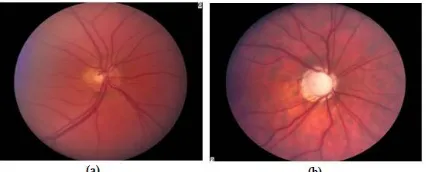Figure 8:  (a) Normal optic nerve - 0.3 C/D ratios (b) Glaucomatous optic nerve – 0.9 C/D ratios