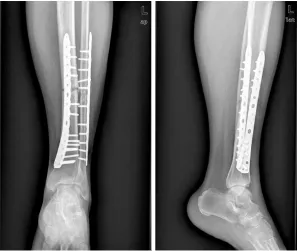 Figure 4. Two-dimensional CT showed bone non-union on October 28th, 2013.