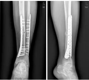 Figure 5. Dynamization surgery: removed 3 locking screws from the center on November 7th, 2013.