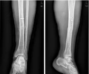 Figure 7. Internal fixation was taken out one year after dynamization surgery, on March 18th, 2015.