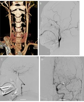 Figure 2. Case 2: A 30 years old male patient with right side weakness and chiocephalic trunk