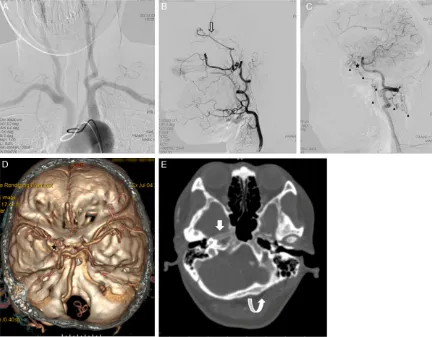 Figure 3. Case 3: A 53 years old female patient with recurrent left headache, intermittent right side weakness and slurred speech