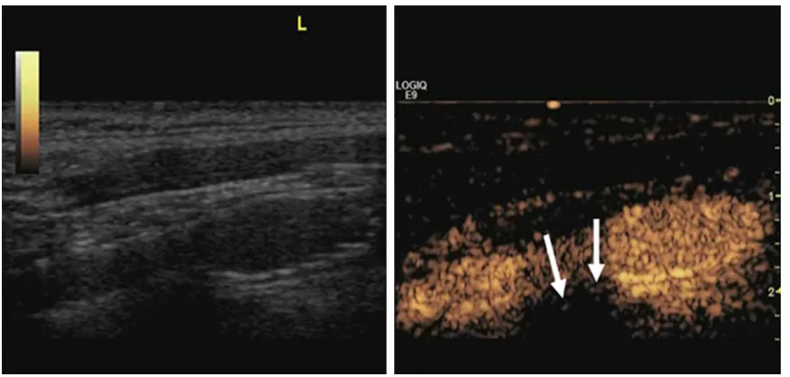 Figure 1. Ultrasound of the left carotid sinus in the transverse plane revealing a low-echo plaque lesion below the stent and the absence of contrast agent in grade 0 plaque (thick arrow).