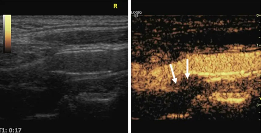 Figure 3. Posterior ultrasound of the right carotid sinus posterior wall revealing the low-echo plaque below the stent and the presence of a large amount of contrast agent diffusely in grade 2 plaque.