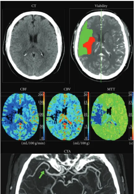 Figure 1: Case 1: 66-year-old male with left-sided stroke symptoms and a normal NECT. Initial comprehensive examination shows reduction of both CBF and CBV in the right hemisphere and an increase in MTT caused by a right-sided M2-segment MCA occlusion (arr